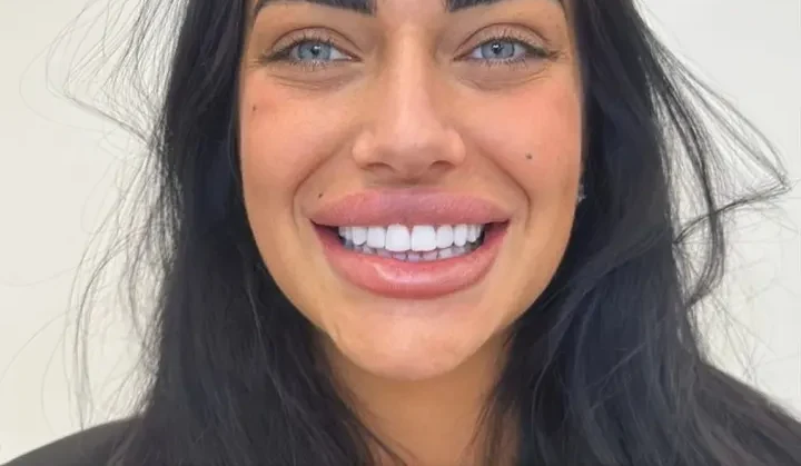 Composiet Hollywood Smile – resultaat