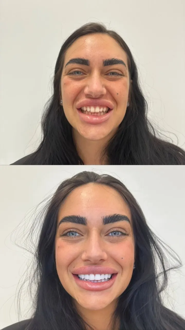 Composiet Hollywood Smile – voor en na